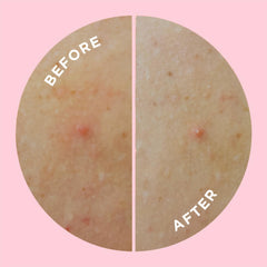 ZitSticka ingredients label highlighting salicylic acid and niacinamide