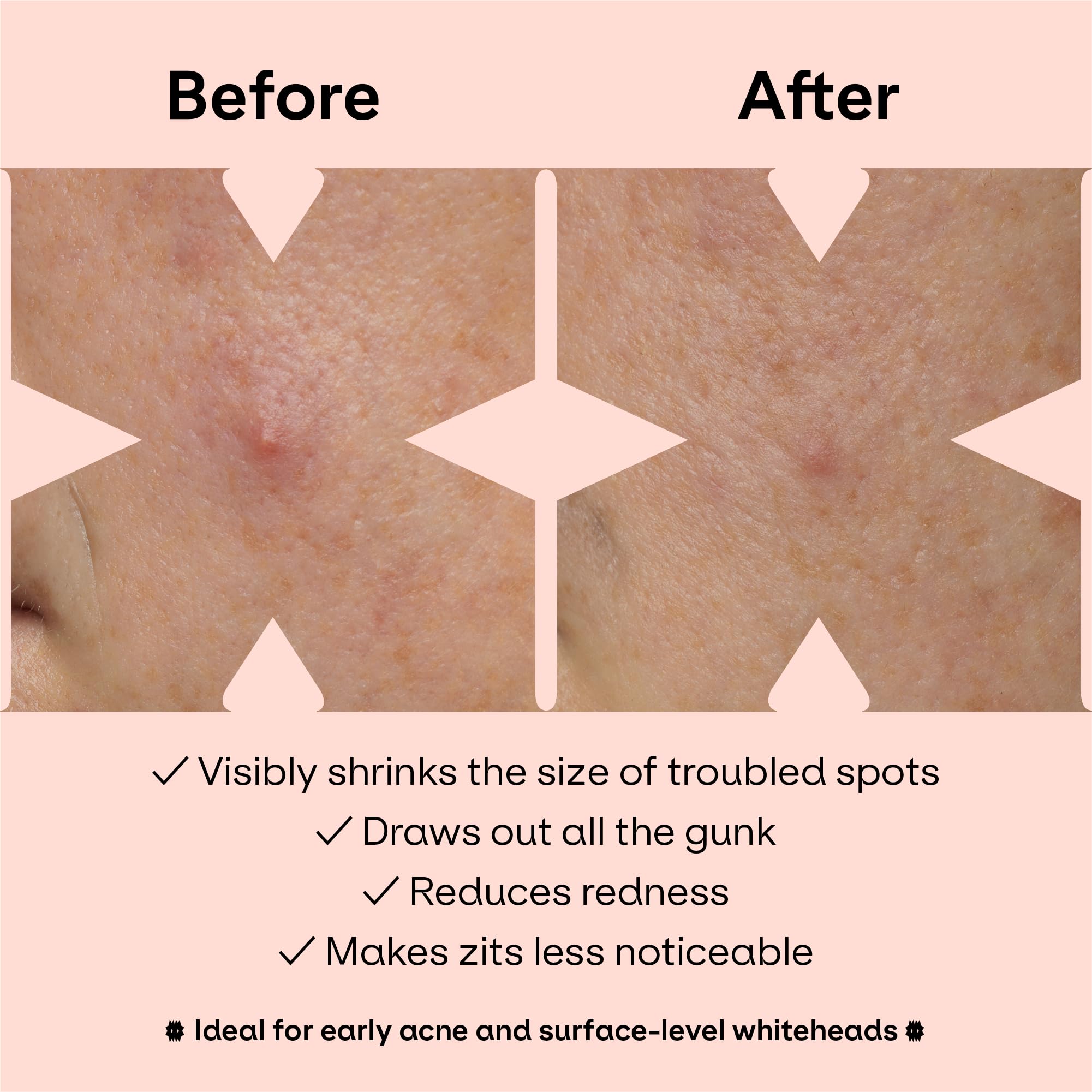 ZVYK patch with salicylic acid callout highlighting gentle exfoliating benefit