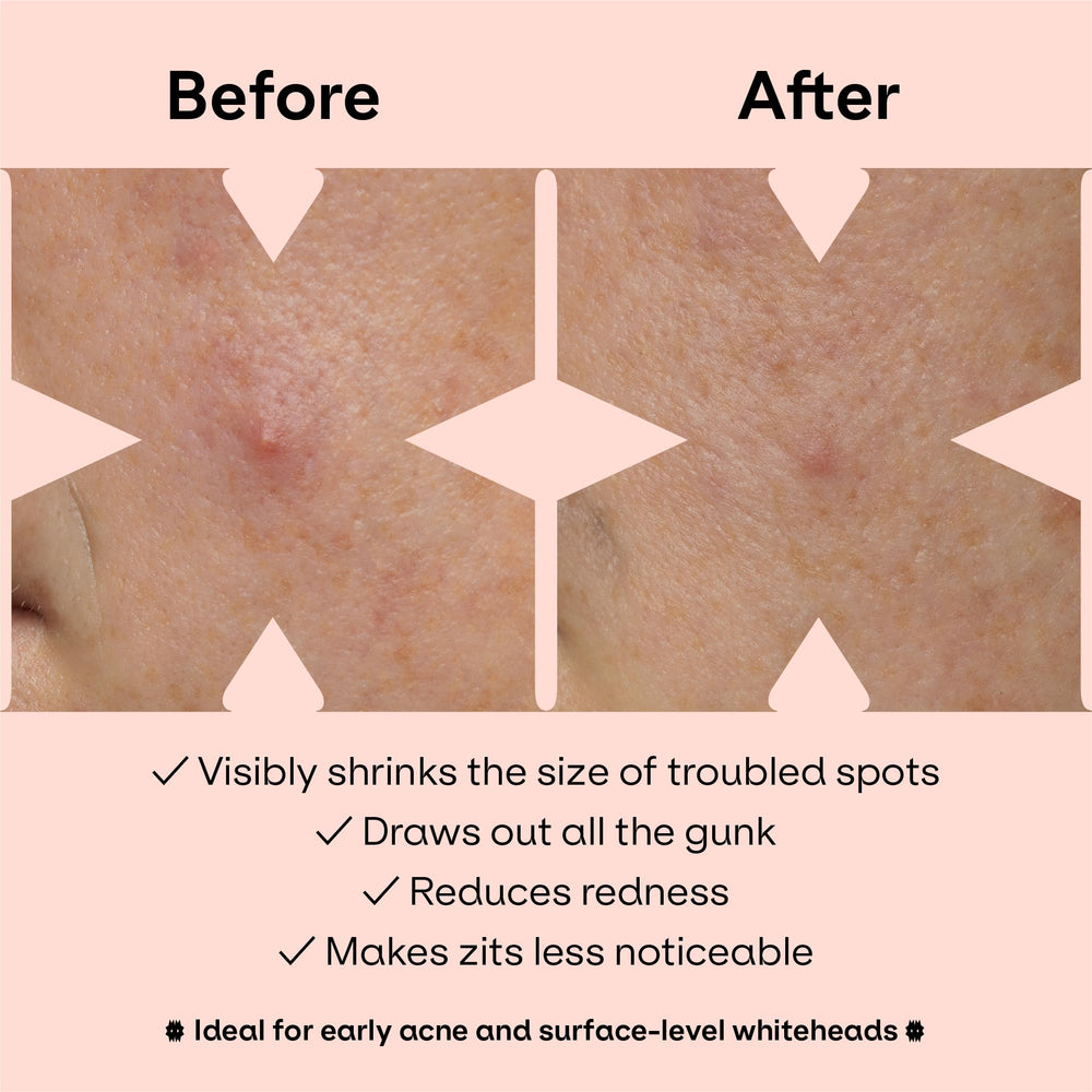 ZVYK patch with salicylic acid callout highlighting gentle exfoliating benefit