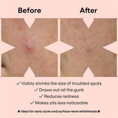 ZVYK patch with salicylic acid callout highlighting gentle exfoliating benefit